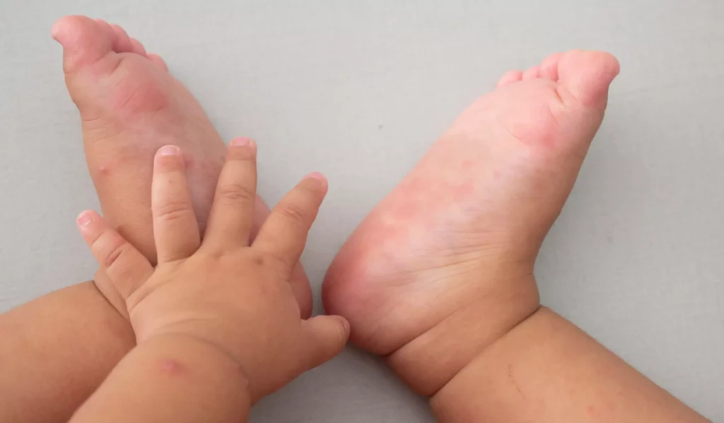 Hand Foot & Mouth Disease