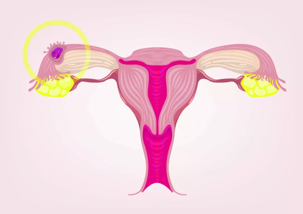 ectopic pregnancy