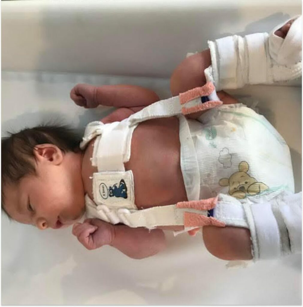 baby with hip dysplasia
