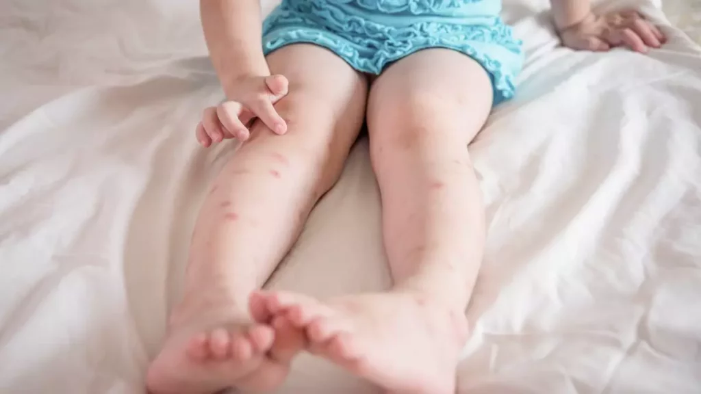 bites and stings