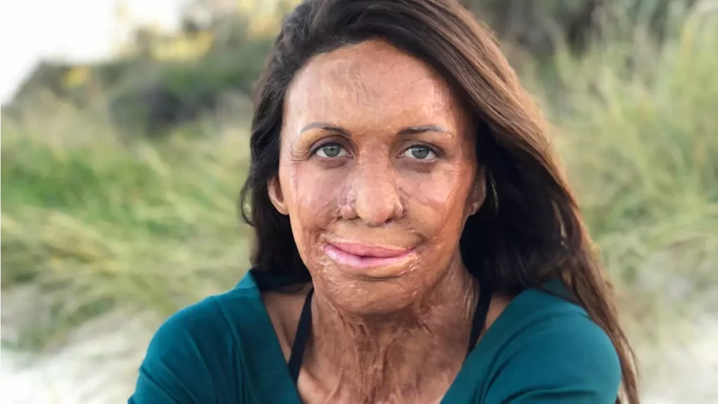 Turia Pitt